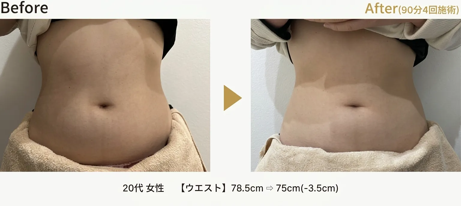 脂肪溶解エステ施術例
