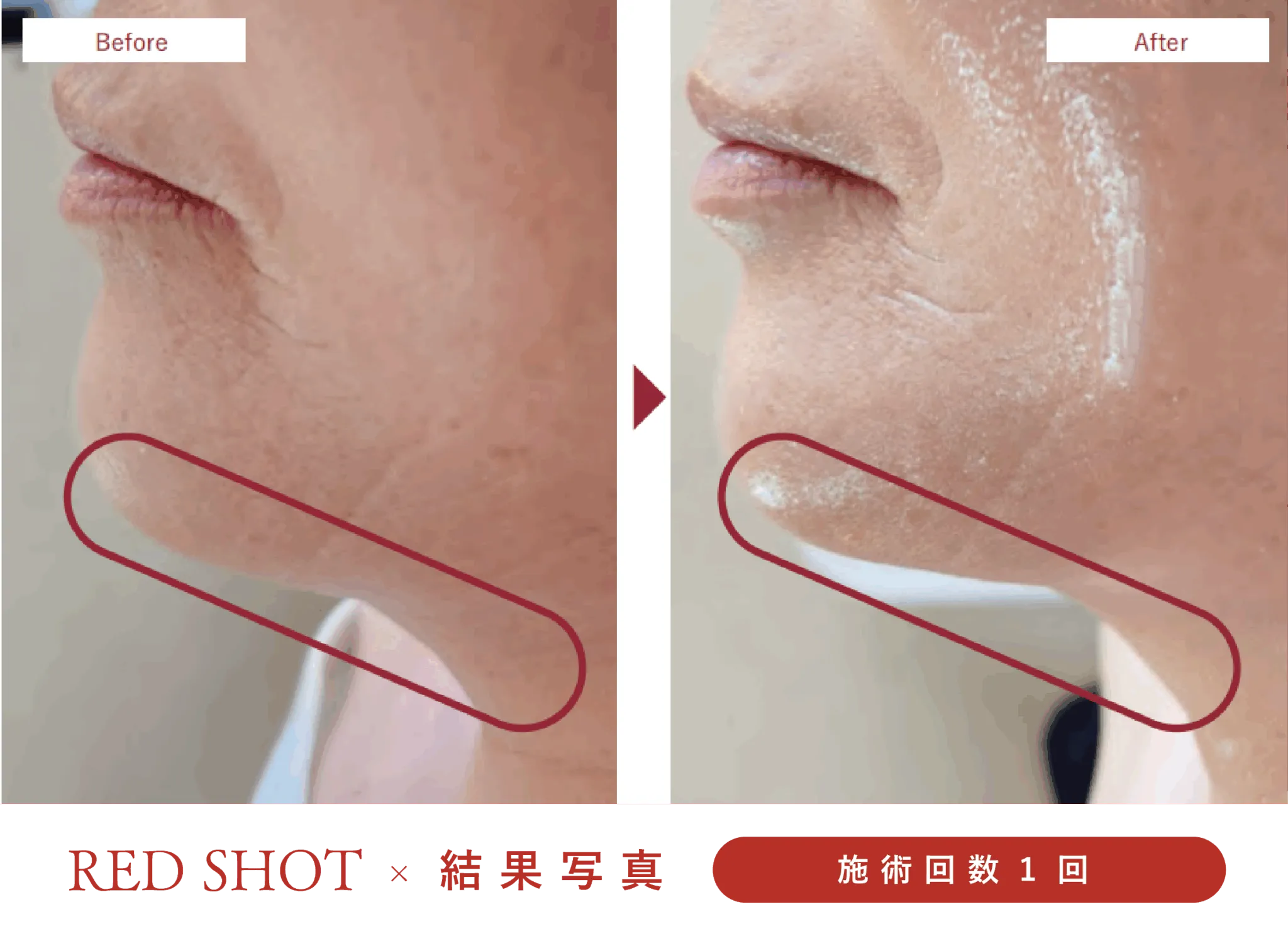 レッドショット
